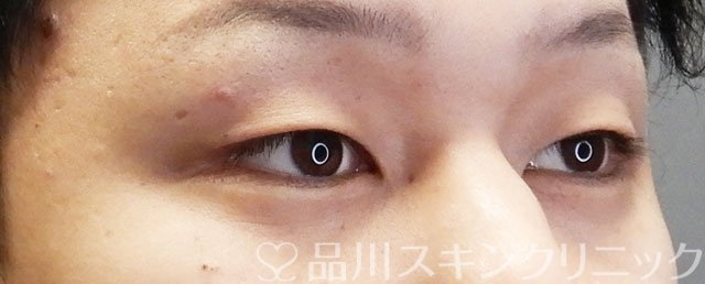 症例NO.74756のBEFORE写真