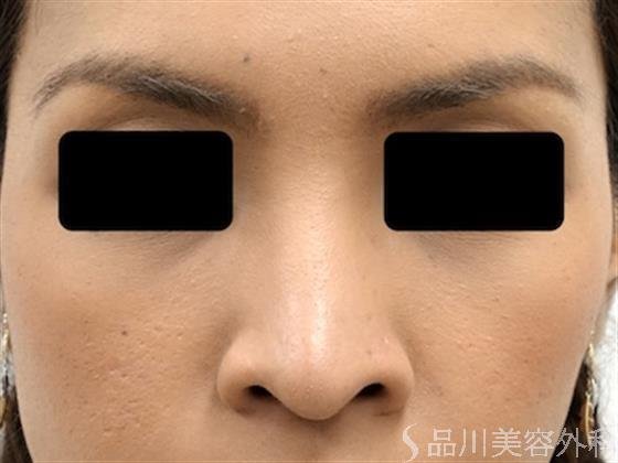 症例NO.24710のBEFORE写真