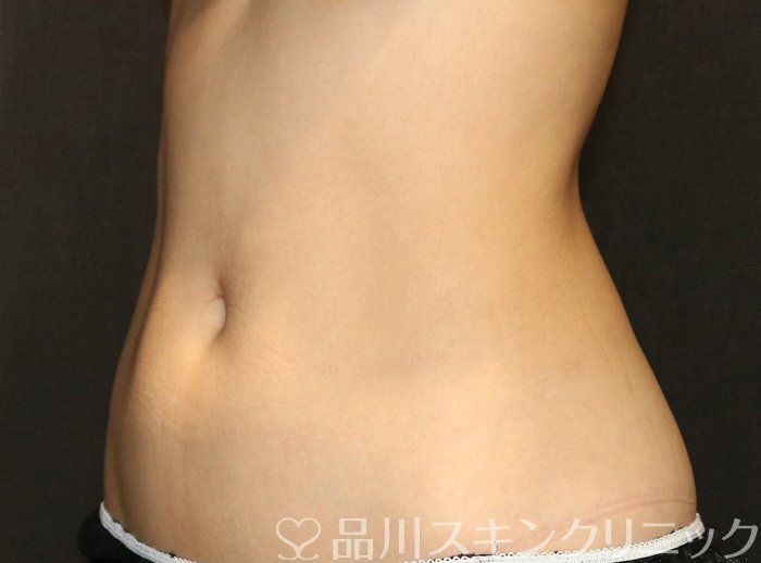 症例NO.69707のAFTER写真