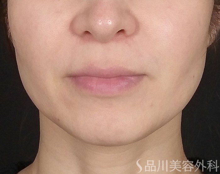 症例NO.65674のBEFORE写真