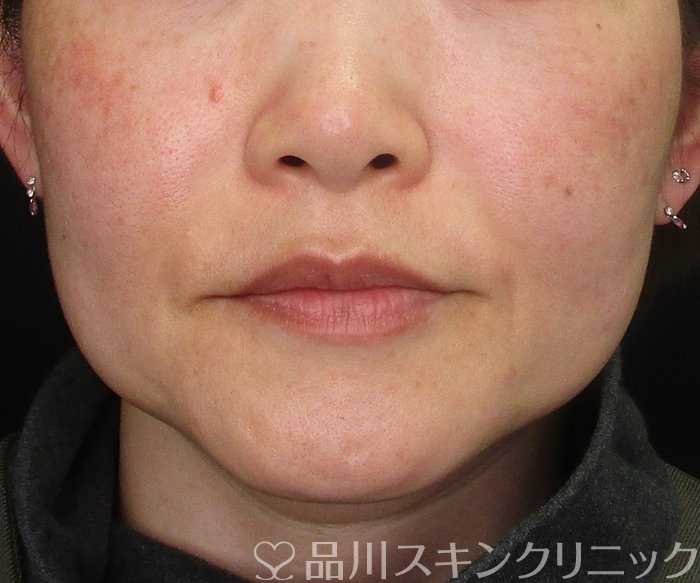 症例NO.75071のBEFORE写真