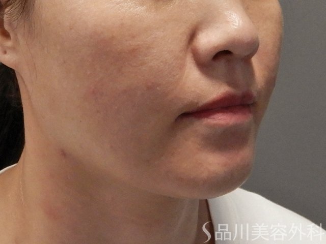 症例NO.71830のBEFORE写真