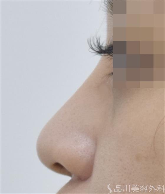 症例NO.50389のAFTER写真