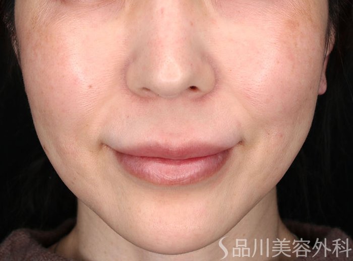 症例NO.69271のBEFORE写真