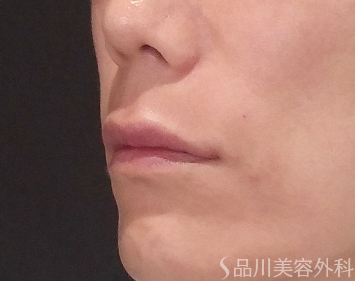 症例NO.70497のAFTER写真