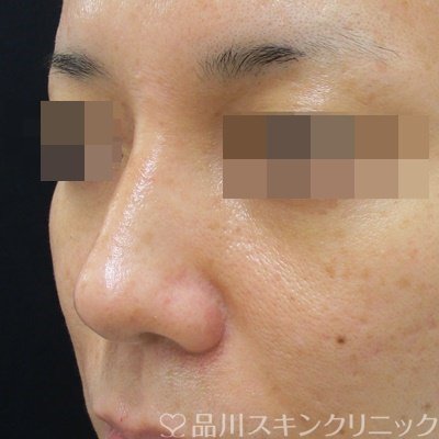 症例NO.71707のAFTER写真