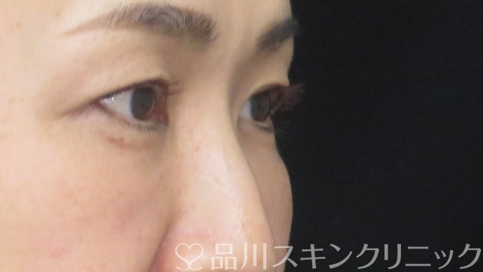 症例NO.72404のAFTER写真