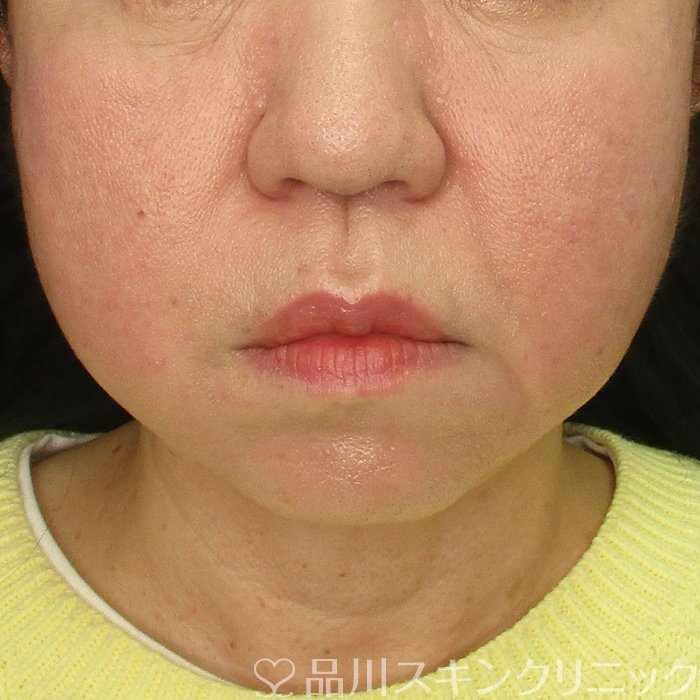 症例NO.72781のAFTER写真