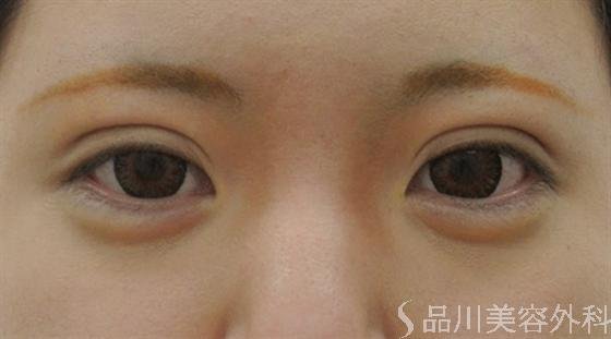 症例NO.16429のAFTER写真