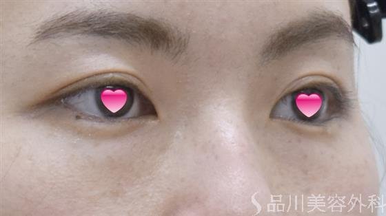 症例NO.52121のBEFORE写真