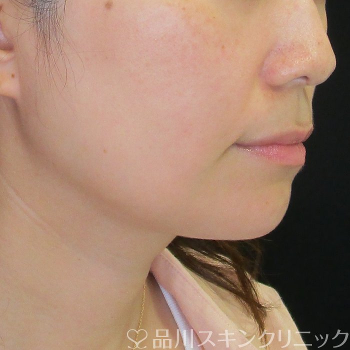 症例NO.69719のBEFORE写真
