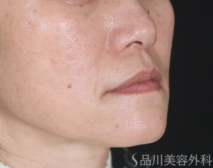 症例NO.73379のAFTER写真