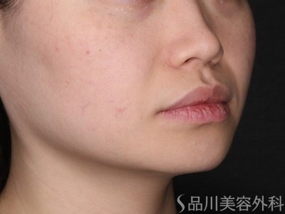 症例NO.70644のAFTER写真