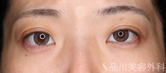 症例NO.69732のAFTER写真