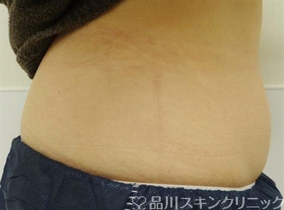 症例NO.35818のBEFORE写真
