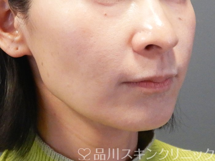 症例NO.74371のBEFORE写真