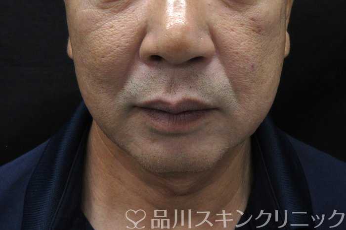 症例NO.74653のBEFORE写真