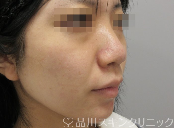 症例NO.71102のBEFORE写真
