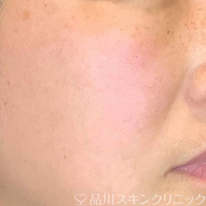 症例NO.69440のAFTER写真