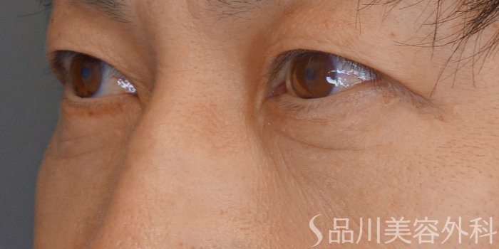 症例NO.71953のAFTER写真