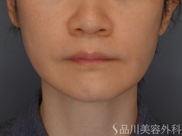 症例NO.72440のBEFORE写真