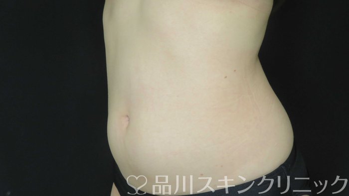 症例NO.72097のBEFORE写真