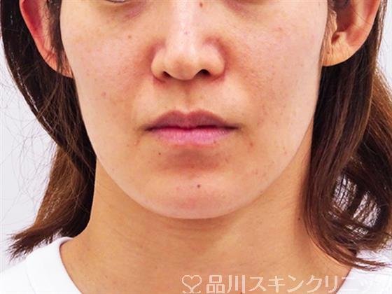 症例NO.52940のBEFORE写真