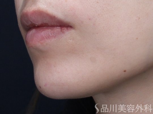 症例NO.73686のAFTER写真