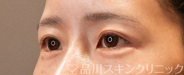 症例NO.70551のAFTER写真