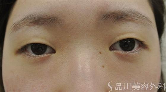 症例NO.16018のBEFORE写真
