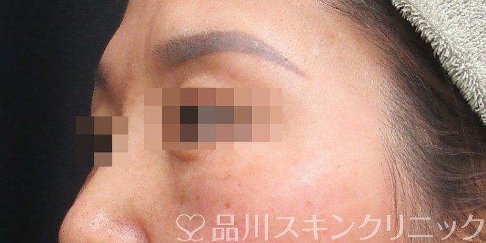 症例NO.72992のBEFORE写真