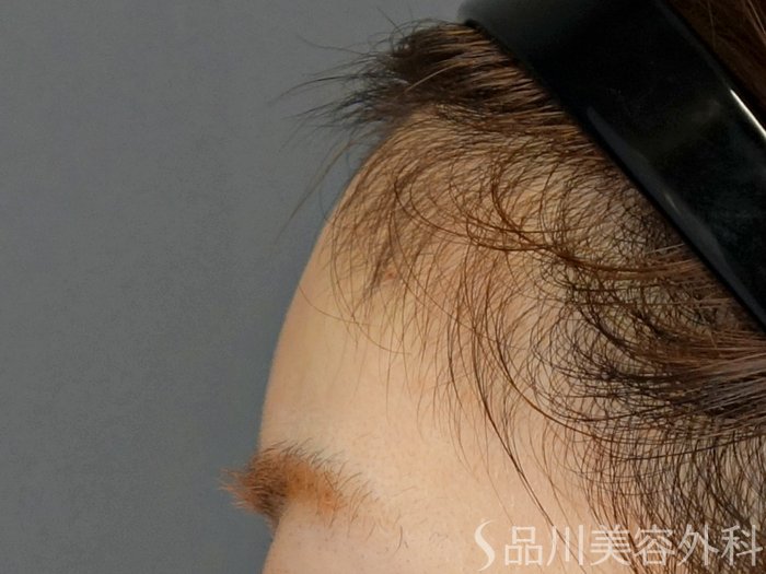 症例NO.72860のAFTER写真