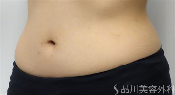 症例NO.46426のBEFORE写真