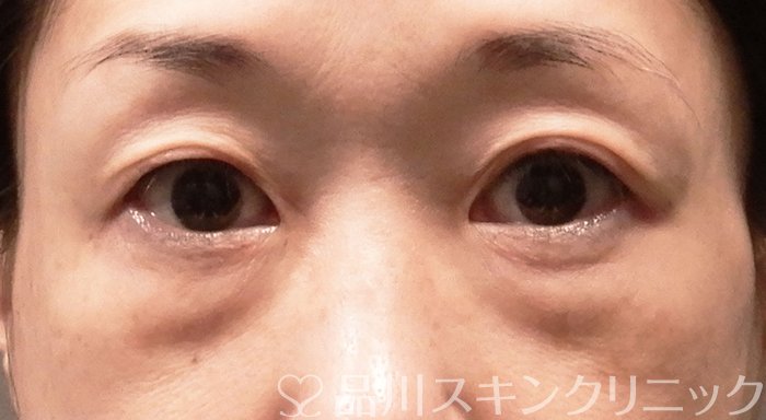 症例NO.69557のBEFORE写真