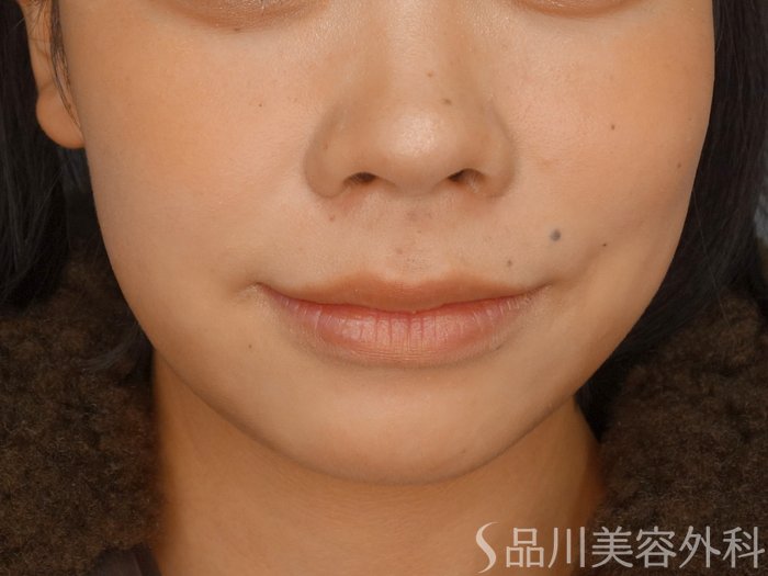 症例NO.73031のBEFORE写真