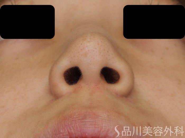 症例NO.71204のAFTER写真