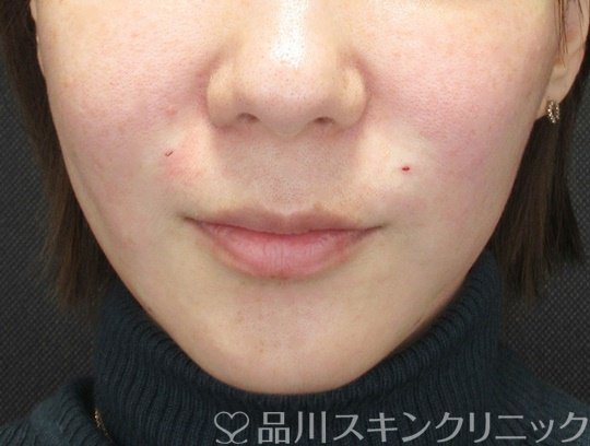 症例NO.69672のAFTER写真