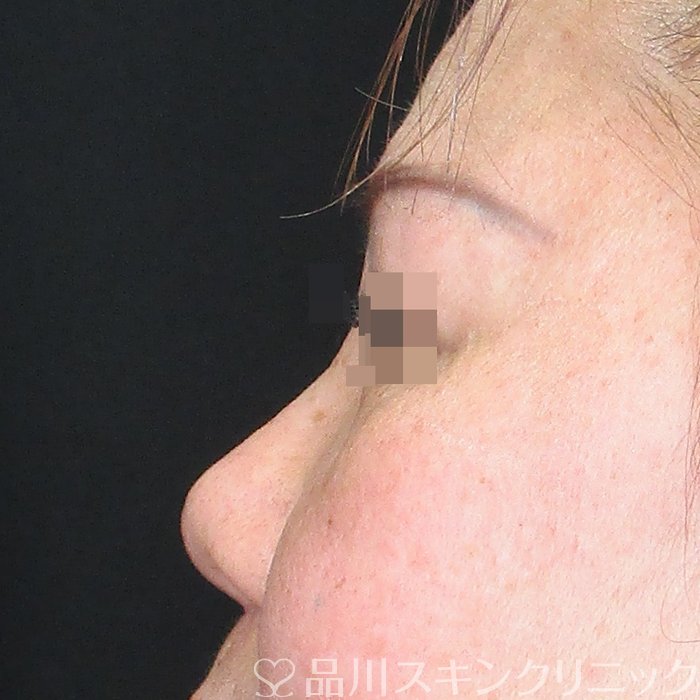 症例NO.73184のBEFORE写真