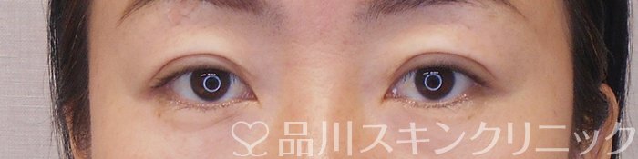 症例NO.70940のAFTER写真