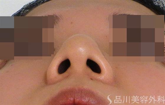 症例NO.39898のBEFORE写真