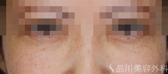 症例NO.51464のAFTER写真