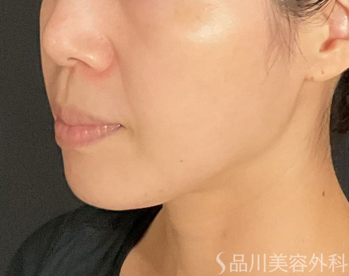 症例NO.74713のBEFORE写真