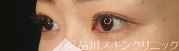 症例NO.65857のAFTER写真