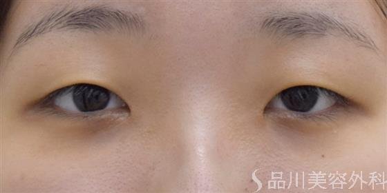 症例NO.61108のBEFORE写真