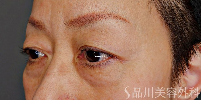 症例NO.73222のBEFORE写真