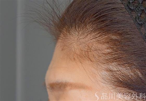 症例NO.54091のBEFORE写真