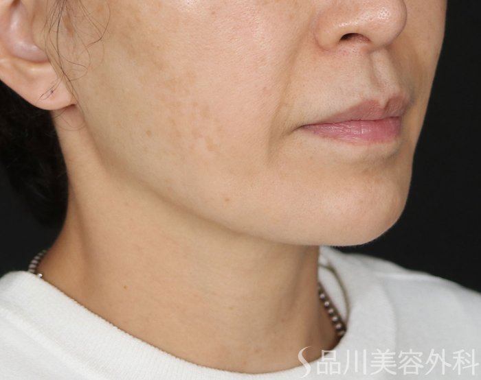 症例NO.73841のBEFORE写真