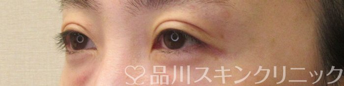 症例NO.74517のAFTER写真