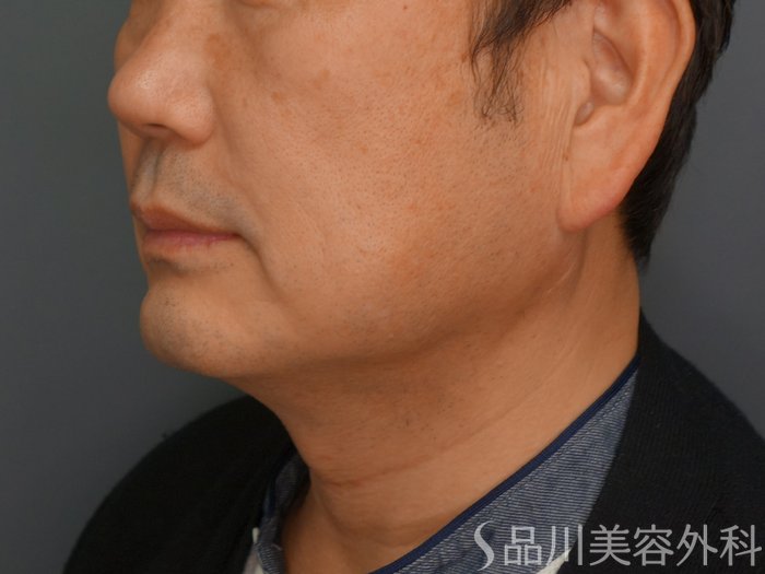 症例NO.74484のBEFORE写真