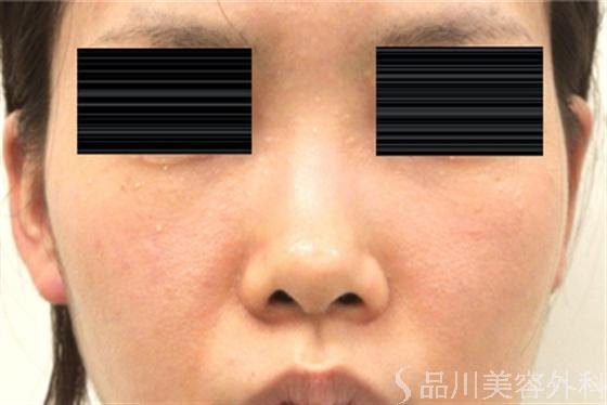 症例NO.20062のBEFORE写真